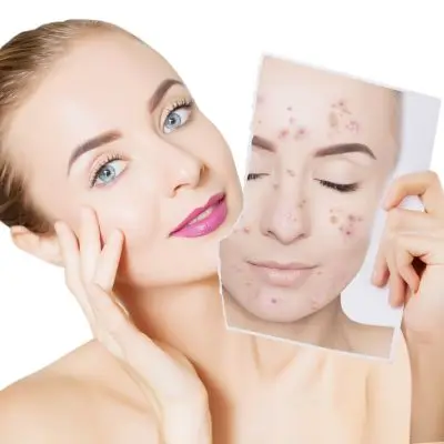 Kit antiacné con productos como ácido salicílico, hidratante y limpiador suave, diseñado para reducir imperfecciones, puntos negros y espinillas. Ejemplo: The Ordinary Acne Set fuente.